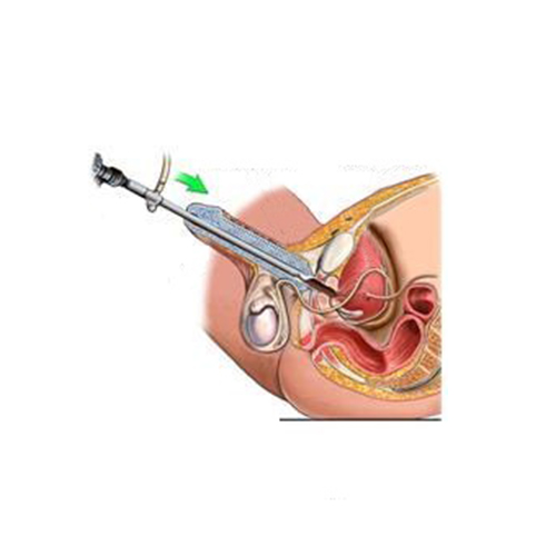 Optical Urethrotomy